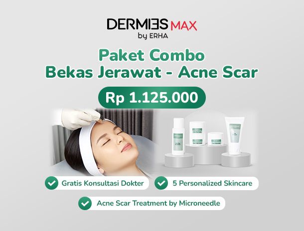 Bekas_Jerawat_Acne_Scar_1_b46c64adb3.jpg