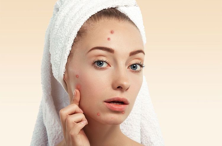 medium_closeup_young_woman_with_towel_head_pimples_face_1_4bff5d9b33.jpg